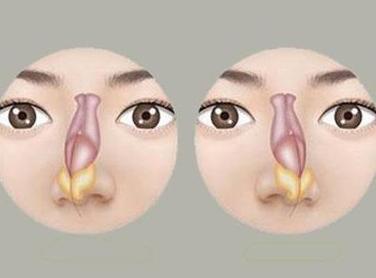 北京膨体隆鼻多少钱？听说膨体容易感染是真的吗？