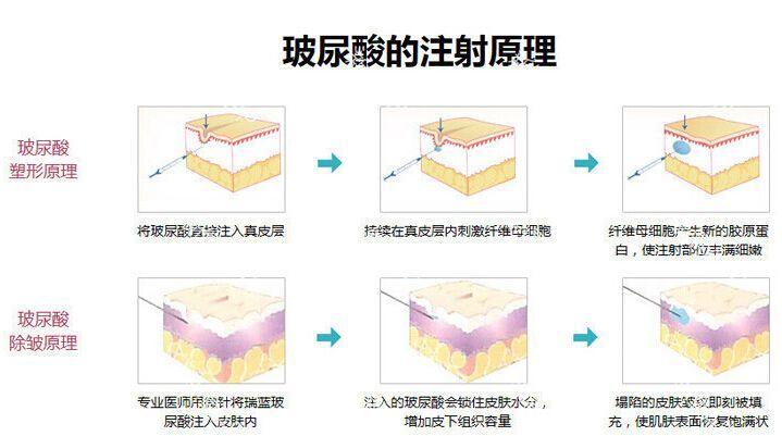 成都玻尿酸隆胸手术费用详解：价格表一览，费用多少，是否价格昂贵？
