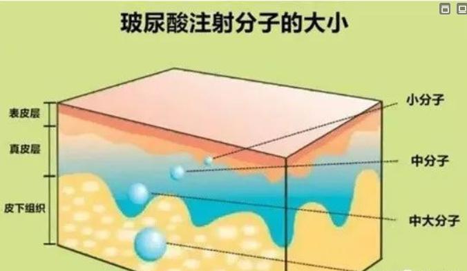 玻尿酸丰唇手术价格表：浙一医院价格表及收费详情解析