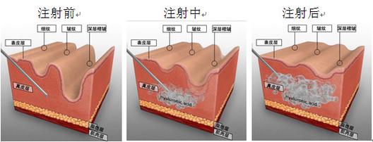 常州伊婉玻尿酸注射价格表：价格表与收费详情解析，了解是否物有所值