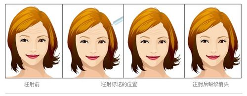 嘉兴玻尿酸除皱价格表：价格表及不同品牌玻尿酸注射收费表分析