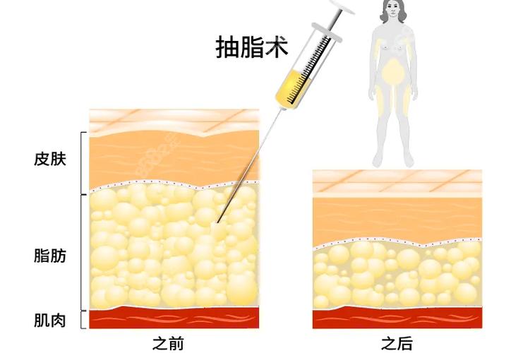 全身抽脂手术费用明细公开，50斤抽脂是否需要5万元？比较不同