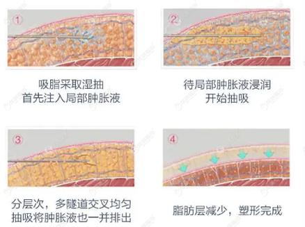 减肥抽脂价位大概费用多少？收费标准是怎样的？