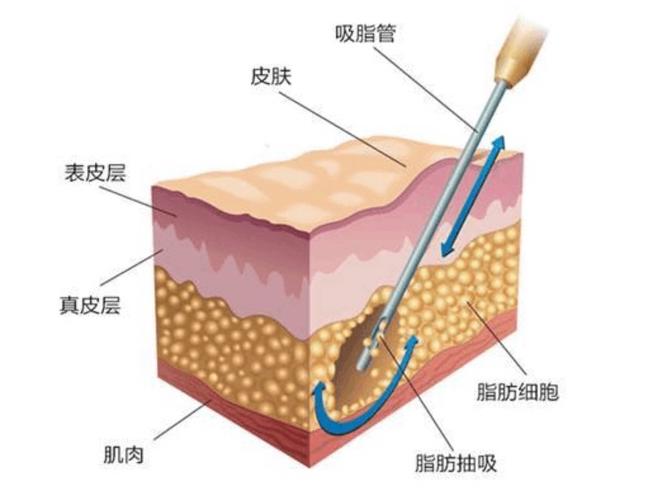 内江腰部抽脂手术手术的费用的因素有哪些