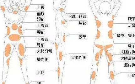 光纤溶脂与抽脂手术费用对比及术后恢复指南：2025年价格表一览