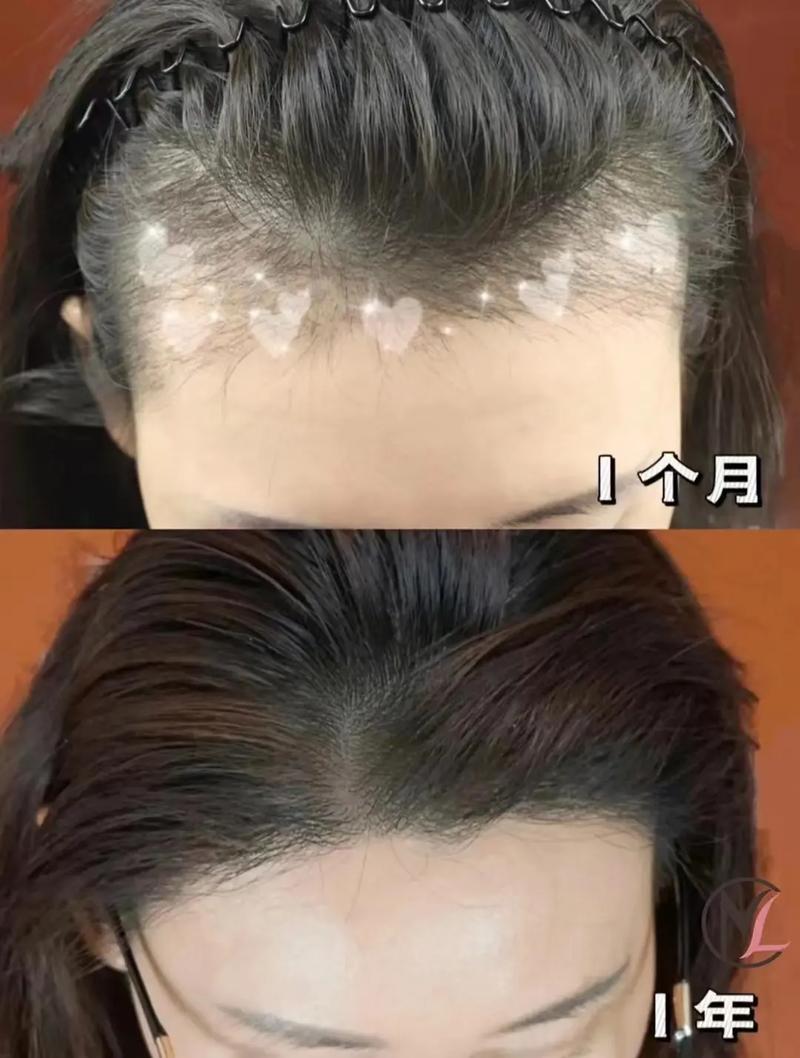 乌鲁木齐发际线植发费用多少？附案例效果对比