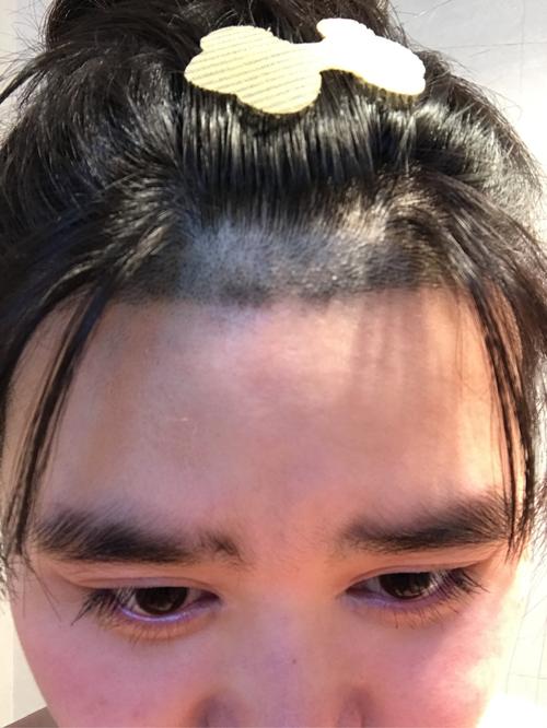 浙一医院植发收费标准，发际线后移手术经历分享