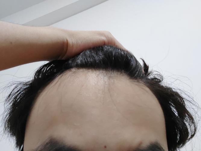 昆明发际线种植手术价格表一览：费用多少？是否值得投资？