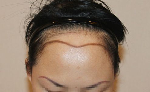 成美植发中心实力如何？发际线种植要费用多少？