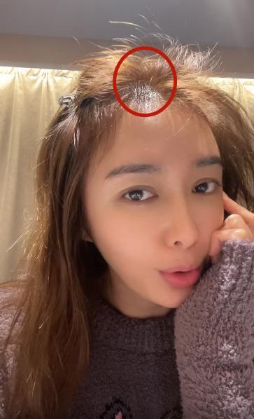 发际线种植手术费用详解：价格表一览，了解各项费用多少，选择性价比高的医