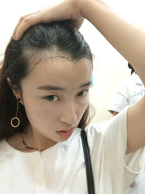 石家庄科发源植发医院发际线种植手术特点 多久能恢复