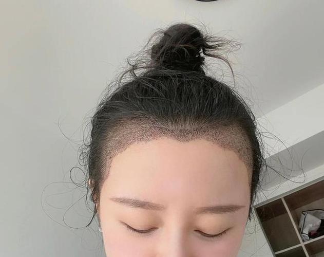 重庆长城医院植发靠谱吗  发际线种植需要多少钱