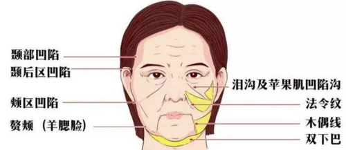 费缦胶原蛋白注射价格一览：不同用量费用多少，效果维持时间及护理要点解析