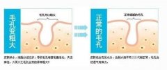 毛孔粗大光子嫩肤有用吗