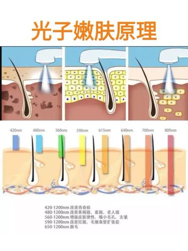 光子嫩肤原理是什么 上海美之源整形医院靠谱吗