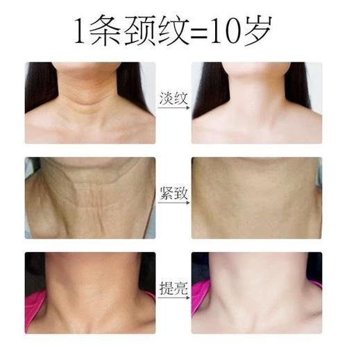 嗨体去颈纹怎么样？不要让年轻的自己受到颈纹的困扰！