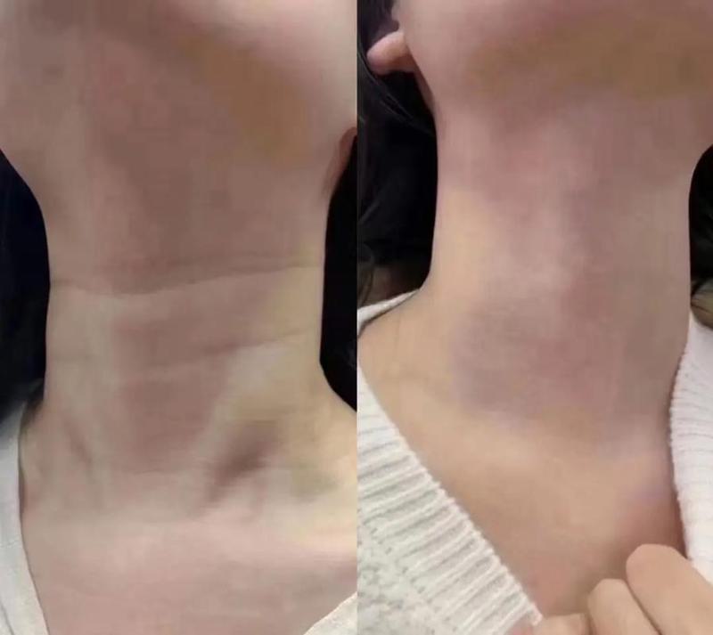 嗨体去颈纹手术费用解析：价格范围及维持时间一览，美丽天鹅颈的秘密！