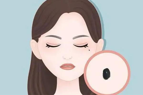点痣手术价格表：不同方法价格差异大，哪种较适合自己的需求？
