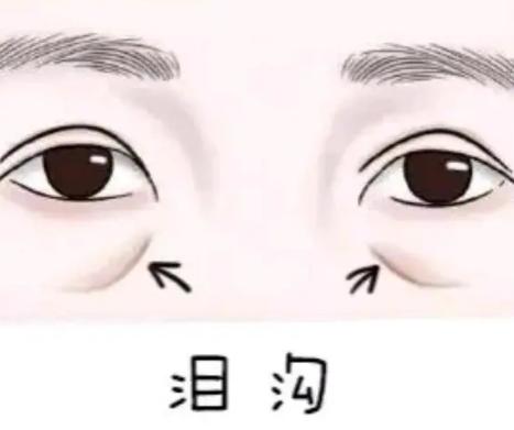 胶原蛋白填充泪沟手术费用明细一览，价格贵吗？效果维持多久解析