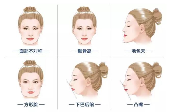 磨骨手术对比照片 效果图 术后恢复注意事项