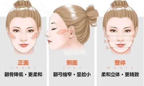 西安微创磨骨手术的费用影响因素有哪些
