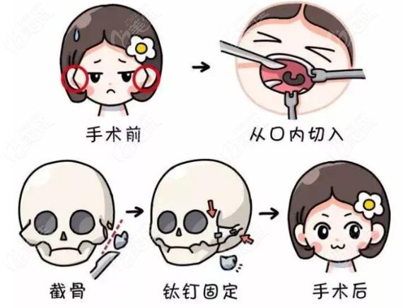 成都整成瓜子脸多少钱 成都整成瓜子脸价目表