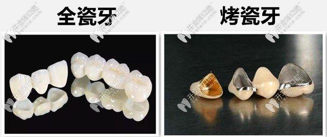 合理选择：全瓷牙的保护与瓷牙为何不被推荐