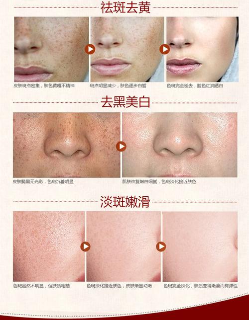 激光祛斑手术费用详解：不同类型斑痣的治疗价格表一览