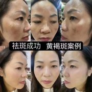 激光祛斑的危害有多大？可能会导致爱美者出现皮肤感染、色素沉着