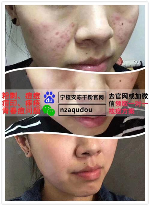 自制补水祛痘面膜教程：价格实惠高效，明星都在用的DIY技巧一览