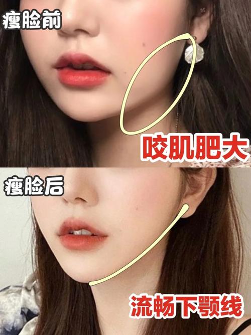 肉毒素瘦脸针价格表一览：费用多少？价格贵吗？不同品牌和剂量的价格差异详