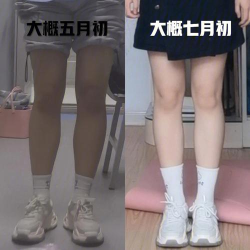 大象腿快看！激光溶脂瘦腿术咱们一起来了解一下