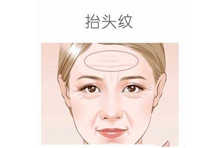 杭州激光去抬头纹哪里做 杭州艺星整形医院激光去抬头纹价格贵吗