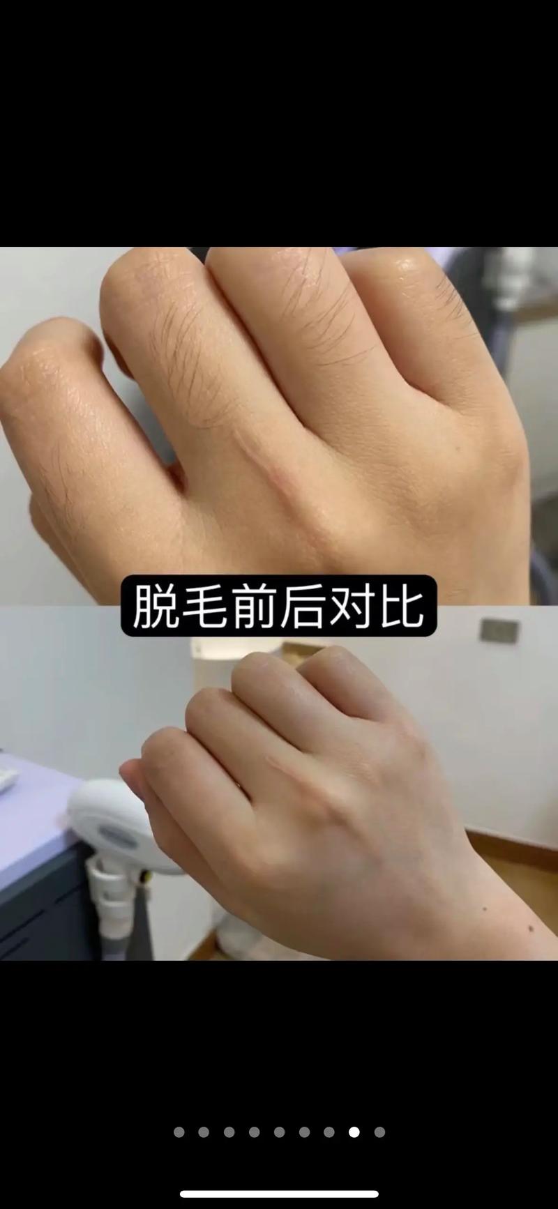 哈尔滨亿星整形医院激光脱腋毛的效果怎么样  安全低风险