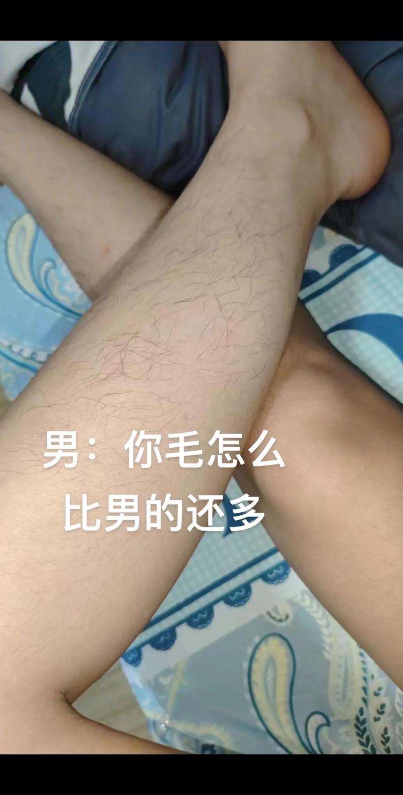 2025年银川医院皮肤科激光脱毛美容费用明细表，腿部脱毛手术案例分享