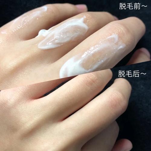 徐州华美整形医院激光脱腋毛怎么样 让你更加自信