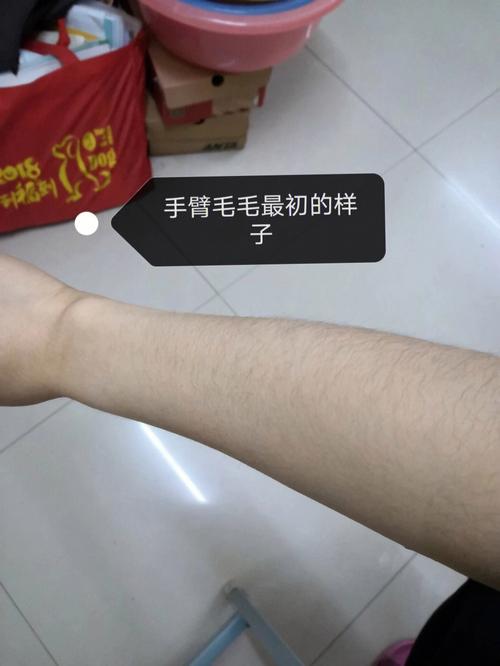 天津冰点e光脱毛价格大概多少？比北上广低吗？
