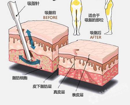 腰腹环形吸脂减肥轻松解决腰部赘肉，你想做吗？