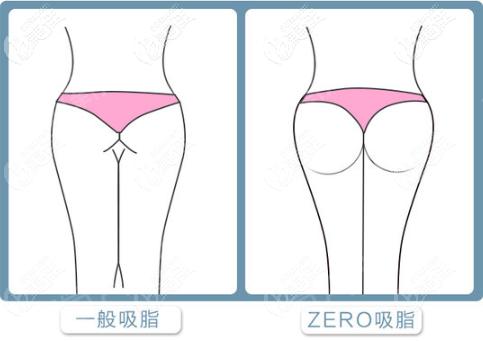 吸脂手臂手术费用多少？解析价格表一览，了解是否价格贵
