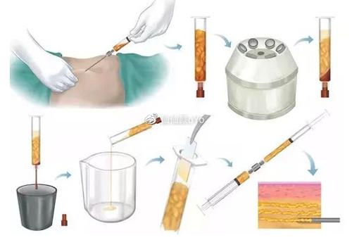 腰腹部吸脂瘦身效果不错 邢台仁爱医院整形科给你好身材