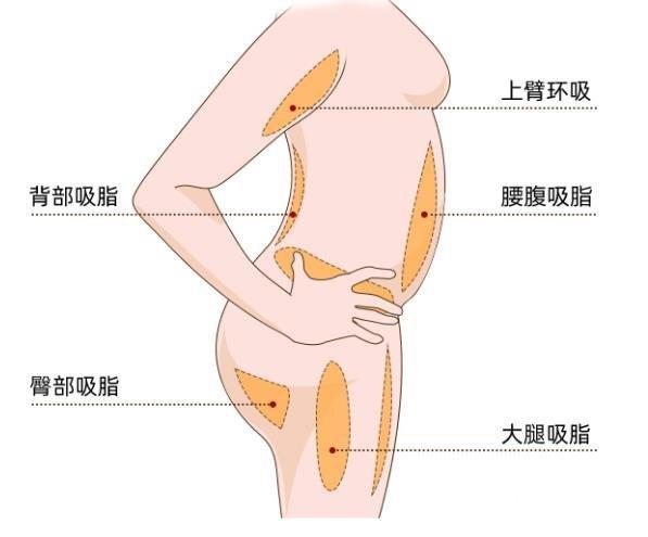 超声波吸脂的价格大致在什么范围？