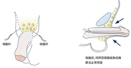 咸阳华尔整形医院面部吸脂恢复快吗 效果怎么样呢