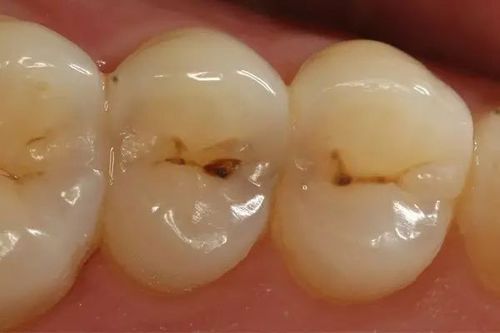 消化道疾病与口腔溃疡是否相关？如何有效预防口腔溃疡发生？