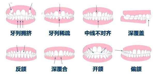 龅牙矫正套装：看牙齿龅厉害程度，有效修复需多久