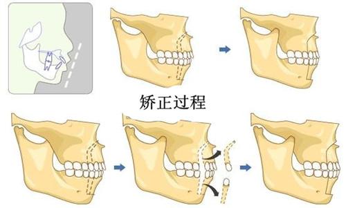 长沙中心医院牙科收费标准，龅牙牙套前后对比