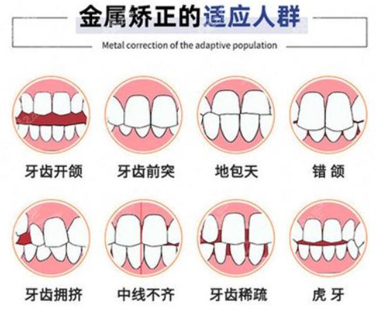 贵阳牙齿矫正价格表，带牙套可以改变脸型~