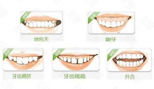 济南口腔医院正畸价目表，骨性突出整牙经历