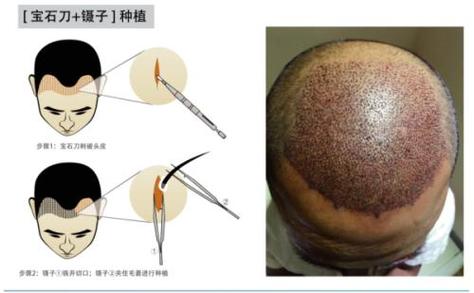 重庆植发哪里好  重庆重生植发整形医院阴毛种植的特点