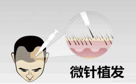 植发手术费用全解析：不同类型手术价格表一览，费用贵吗？