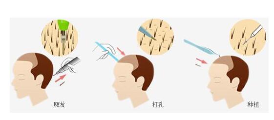 北京植发哪里好 北京壹加壹植发医院头发种植有哪些优势